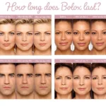 How Long Does Botox Last? The Truth Behind the Smooth Look