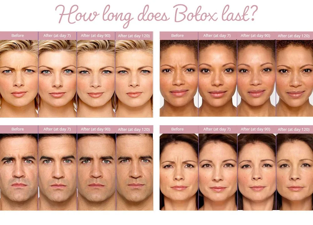 How Long Does Botox Last? The Truth Behind the Smooth Look